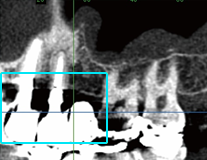 当院の歯科用CT：金属の周りでも骨の状態を診断できます。