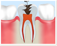 重度の虫歯でも歯を残す治療法――根管治療