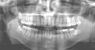 従来のパノラマレントゲン