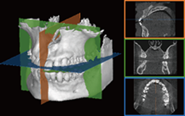歯科用CT