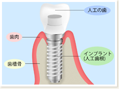 インプラントって？