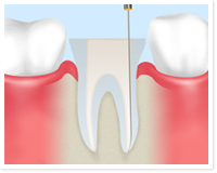 歯髄を取り、きれいにします
