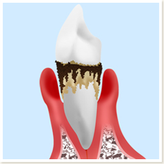 虫歯と同様に歯周病にも注意が必要です